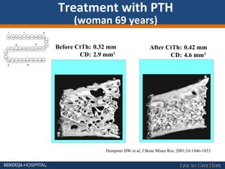 Treatment with PTH
(woman 69 years)
Dempster DW et al, J Bone Miner Res, 2001;16:1846-1853
Before CtTh: 0.32 mm
CD: 2.9 mm3
After CtTh: 0.42 mm
CD: 4.6 mm3
1 5 10
1520
25 30
Ser Val Ser Glu Ile Gln Leu Met His Asn
Leu
Gly
LysHisLeuAsnSerMetGluArgValGlu
Trp
Leu
Arg Lys Lys Leu Gln Asp Val His Asn Phe
 