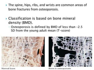 



The spine, hips, ribs, and wrists are common areas of
bone fractures from osteoporosis.
Classification is based on bone mineral
density (BMD).
◦ Osteoporosis is defined by BMD of less than –2.5
SD from the young adult mean (T-score)

 