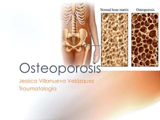 Jessica Villanueva Velázquez
Traumatología
Osteoporosis
 