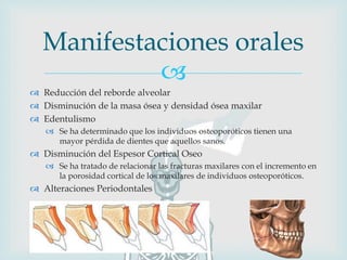
 Reducción del reborde alveolar
 Disminución de la masa ósea y densidad ósea maxilar
 Edentulismo
 Se ha determinado que los individuos osteoporóticos tienen una
mayor pérdida de dientes que aquellos sanos.
 Disminución del Espesor Cortical Oseo
 Se ha tratado de relacionar las fracturas maxilares con el incremento en
la porosidad cortical de los maxilares de individuos osteoporóticos.
 Alteraciones Periodontales
Manifestaciones orales
 