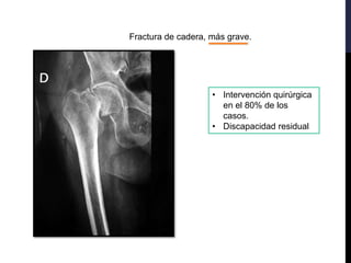 Fractura de cadera, más grave.
• Intervención quirúrgica
en el 80% de los
casos.
• Discapacidad residual
 