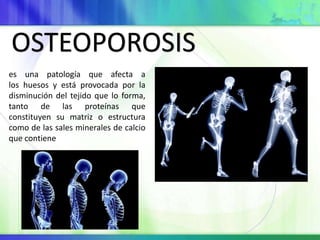 OSTEOPOROSIS 
es una patología que afecta a 
los huesos y está provocada por la 
disminución del tejido que lo forma, 
tanto de las proteínas que 
constituyen su matriz o estructura 
como de las sales minerales de calcio 
que contiene 
 