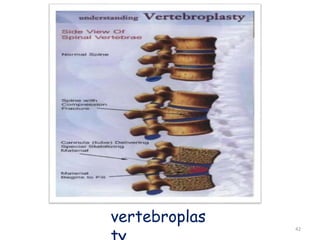 vertebroplas 
ty 42 
 