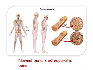 Normal bone x osteoporotic 
bone 5 
 