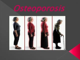 Osteoporosis
 