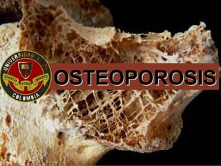 OSTEOPOROSISOSTEOPOROSIS
 