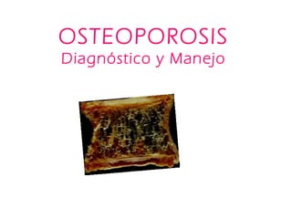 OSTEOPOROSIS
Diagnóstico y Manejo
 