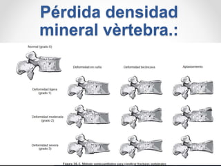 Pérdida densidad
mineral vèrtebra.:
 