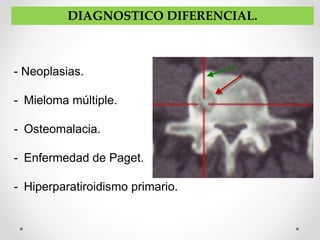 DIAGNOSTICO DIFERENCIAL.
- Neoplasias.
- Mieloma múltiple.
- Osteomalacia.
- Enfermedad de Paget.
- Hiperparatiroidismo primario.
 