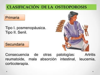 CLASIFICACIÓN DE LA OSTEOPOROSIS
Primaria
Tipo I. posmenopáusica.
Tipo II. Senil.
Secundaria
Consecuencia de otras patologías: Artritis
reumatoide, mala absorción intestinal, leucemia,
corticoterapia.
 