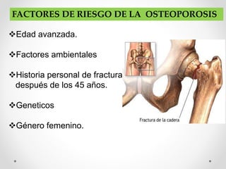 FACTORES DE RIESGO DE LA OSTEOPOROSIS
Edad avanzada.
Factores ambientales
Historia personal de fractura
después de los 45 años.
Geneticos
Género femenino.
 