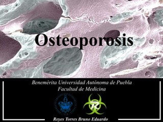 Osteoporosis
Reyes Torres Bruno Eduardo
Benemérita Universidad Autónoma de Puebla
Facultad de Medicina
 