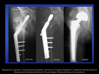 Osteoporosis y fracturas. Una perspectiva ortopédica. Iniciativa de Cirujanos Ortopédicos. Fundación Internacional de la
Osteoporosis International Society for Fracture Repair. Década del hueso y la articulación.
 