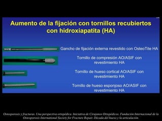 Osteoporosis y fracturas. Una perspectiva ortopédica. Iniciativa de Cirujanos Ortopédicos. Fundación Internacional de la
Osteoporosis International Society for Fracture Repair. Década del hueso y la articulación.
 