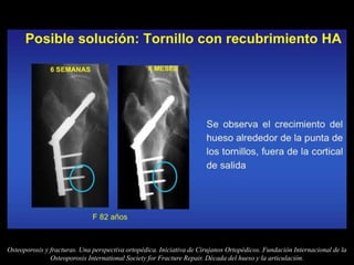 Osteoporosis y fracturas. Una perspectiva ortopédica. Iniciativa de Cirujanos Ortopédicos. Fundación Internacional de la
Osteoporosis International Society for Fracture Repair. Década del hueso y la articulación.
 