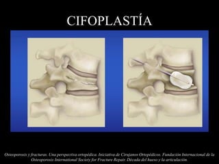 CIFOPLASTÍA
Osteoporosis y fracturas. Una perspectiva ortopédica. Iniciativa de Cirujanos Ortopédicos. Fundación Internacional de la
Osteoporosis International Society for Fracture Repair. Década del hueso y la articulación.
 