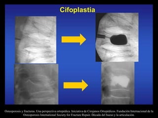 Osteoporosis y fracturas. Una perspectiva ortopédica. Iniciativa de Cirujanos Ortopédicos. Fundación Internacional de la
Osteoporosis International Society for Fracture Repair. Década del hueso y la articulación.
 