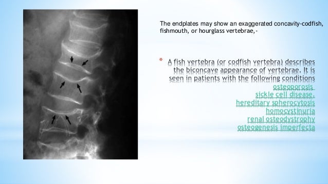 Imaging in Osteoporosis and Paget's disease