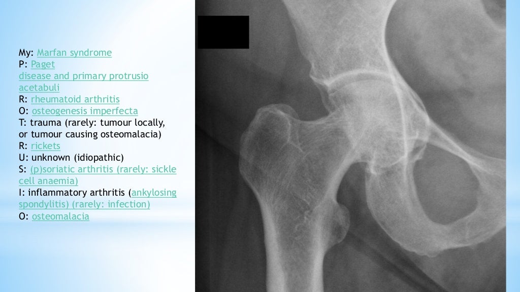 Imaging in Osteoporosis and Paget's disease