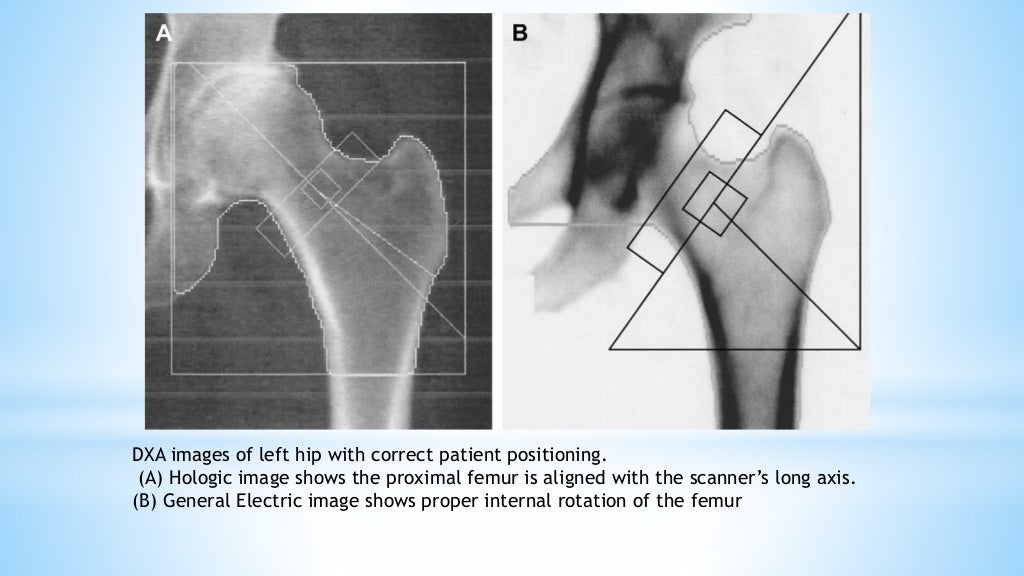 Imaging in Osteoporosis and Paget's disease