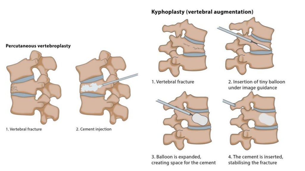 Osteoporosis surgical Spine tips and tricks