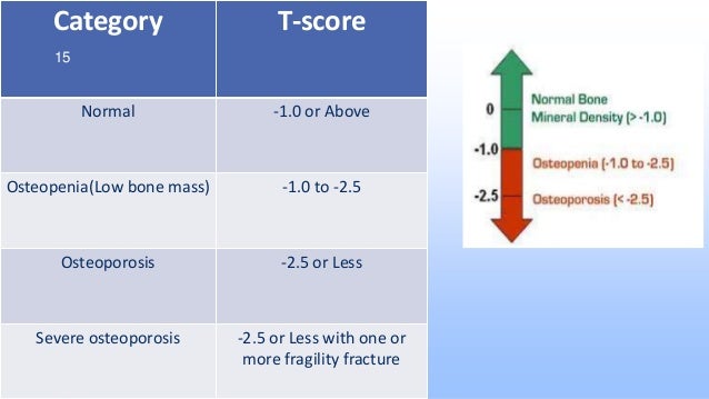Osteoporosis osteoporosis