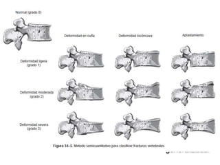 Rx. simples
La proyección lateral de columna torácica y
lumbar permite demostrar la mayor parte de
las fracturas.
Acuñamiento
Al perder altura
en una parte del
cuerpo vertebral.
Deformidad
bicóncava
Aplastamiento en
el centro del
cuerpo vertebral
Colapso vertebral
total
Altura del cuerpo
vertebral se
disminuye en
forma
generalizada.
 