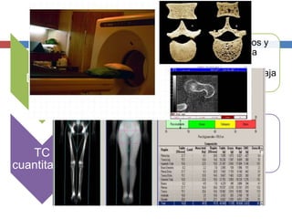 DEXA
• Incorpora la atenuación de tejidos blandos y
huesos mediante rayos X para calcular la
DMO
• Técnica precisa y segura (radiaciones de baja
intensidad).
TC
cuantitativa
• Permite determinar la pérdida de hueso
trabecular (de la columna vertebral)
• Implica niveles de radiación, tiempo de
exposición y errores de precisión; mayores.
 