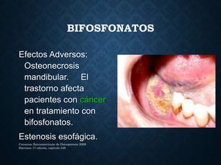 BIFOSFONATOS
Efectos Adversos:
Osteonecrosis
mandibular. El
trastorno afecta
pacientes con cáncer
en tratamiento con
bifosfonatos.
Estenosis esofágica.
Consenso Iberoamericano de Osteoporosis 2009
Harrison 17 edición, capitulo 348
 