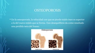 OSTEOPOROSIS
• En la osteoporosis, la velocidad con que se pierde tejido óseo es superior
a la del nuevo tejido que se forma. Este desequilibrio da como resultado
una perdida neta del hueso.
 