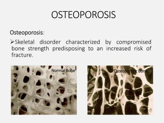 OSTEOPOROSIS
Osteoporosis:
Skeletal disorder characterized by compromised
bone strength predisposing to an increased risk of
fracture.
Normal Bone Osteoporotic Bone
 