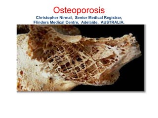 Osteoporosis
Christopher Nirmal, Senior Medical Registrar,
Flinders Medical Centre, Adelaide, AUSTRALIA.
 