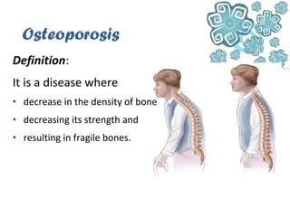 Osteoporosis
Definition:
It is a disease where
• decrease in the density of bone
• decreasing its strength and
• resulting in fragile bones.
 