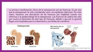 • La primera manifestación clínica de la osteoporosis son las fracturas. Es por eso
que la osteoporosis ha sido considerada como una epidemia silenciosa. Por esta
razón, hacemos una descripción de las fracturas por fragilidad cuando nos
referimos a la epidemiología de la osteoporosis. Las fracturas de cadera han sido
por mucho el barómetro de este tipo de fracturas, debido a que por lo general
llegan a los hospitales para su tratamiento y son fáciles de cuantificar.
REVISTA COLOMBIANA DE REUMATOLOGÍA VOL. 16 No. 1, Marzo 2009, pp. 61-75
© 2009, Asociación Colombiana de Reumatología
 