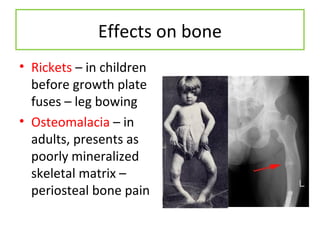 Effects on bone
• Rickets – in children
before growth plate
fuses – leg bowing
• Osteomalacia – in
adults, presents as
poorly mineralized
skeletal matrix –
periosteal bone pain
 