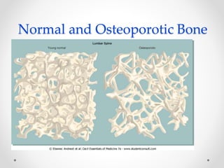 Normal and Osteoporotic Bone
 