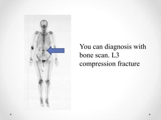 You can diagnosis with
bone scan. L3
compression fracture
 