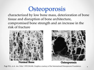 characterized by low bone mass, deterioration of bone
tissue and disruption of bone architecture,
compromised bone strength and an increase in the
risk of fracture
Osteoporosis
Normal Bone Osteoporosis
Peck WA, et al. Am J Med. 1993;94:646. Graphics courtesy of the International Osteoporosis Foundation.
 