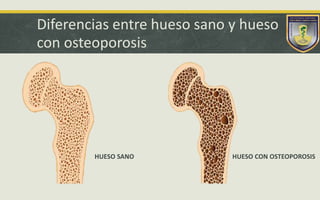 Diferencias entre hueso sano y hueso
con osteoporosis
HUESO SANO HUESO CON OSTEOPOROSIS
 