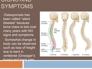 SIGNS AND
SYMPTOMS
•Osteoporosis has
been called “silent
disease” because
bone mass is lost over
many years with NO
signs and symptoms.
• Somewhat change in
body can be observed
such as loss of height
due to bent in
vertebrae (Dowager’s
hump) and back pain.
 