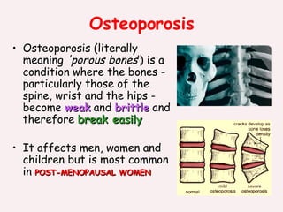 Osteoporosis ,[object Object],[object Object]