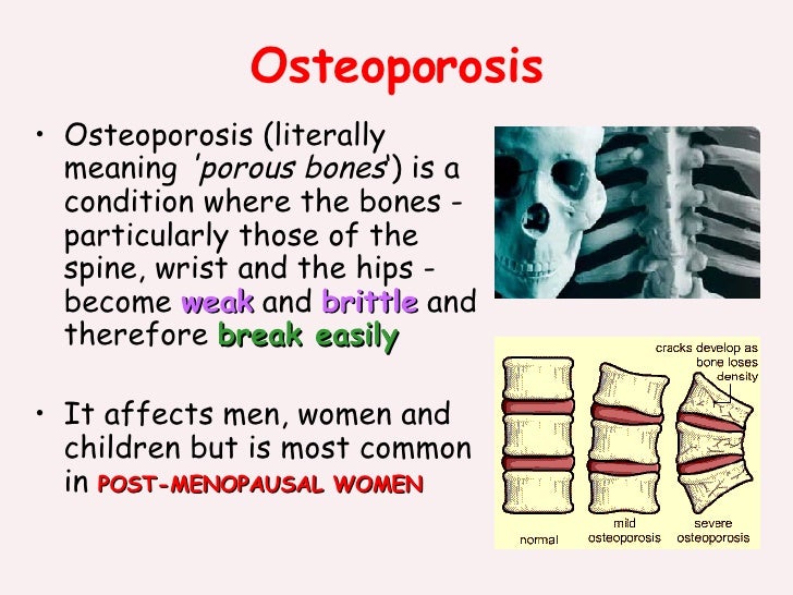 Osteoporosis