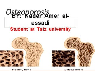 Osteoporosis
BY: Nader Amer al-
assadi
Student at Taiz university
 