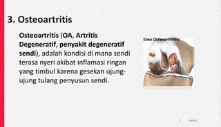3. Osteoartritis
Osteoartritis (OA, Artritis
Degeneratif, penyakit degeneratif
sendi), adalah kondisi di mana sendi
terasa nyeri akibat inflamasi ringan
yang timbul karena gesekan ujung-
ujung tulang penyusun sendi.
Artritis
1
 