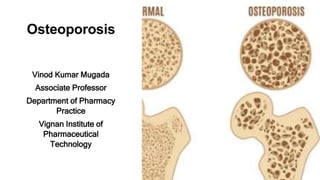 Osteoporosis
Vinod Kumar Mugada
Associate Professor
Department of Pharmacy
Practice
Vignan Institute of
Pharmaceutical
Technology
 