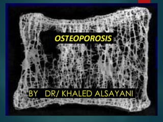 OSTEOPOROSIS
BY DR/ KHALED ALSAYANI
 