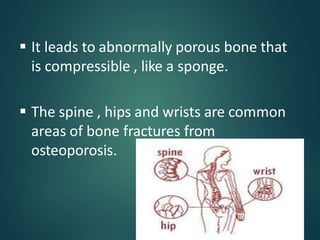  It leads to abnormally porous bone that
is compressible , like a sponge.
 The spine , hips and wrists are common
areas of bone fractures from
osteoporosis.
 