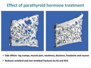 Effect of parathyroid hormone treatment
 Side effects- leg cramps, muscle pain, weakness, dizziness, headache and nausea
 Reduces vertebral and non vertebral fractures by 65 and 45%
 