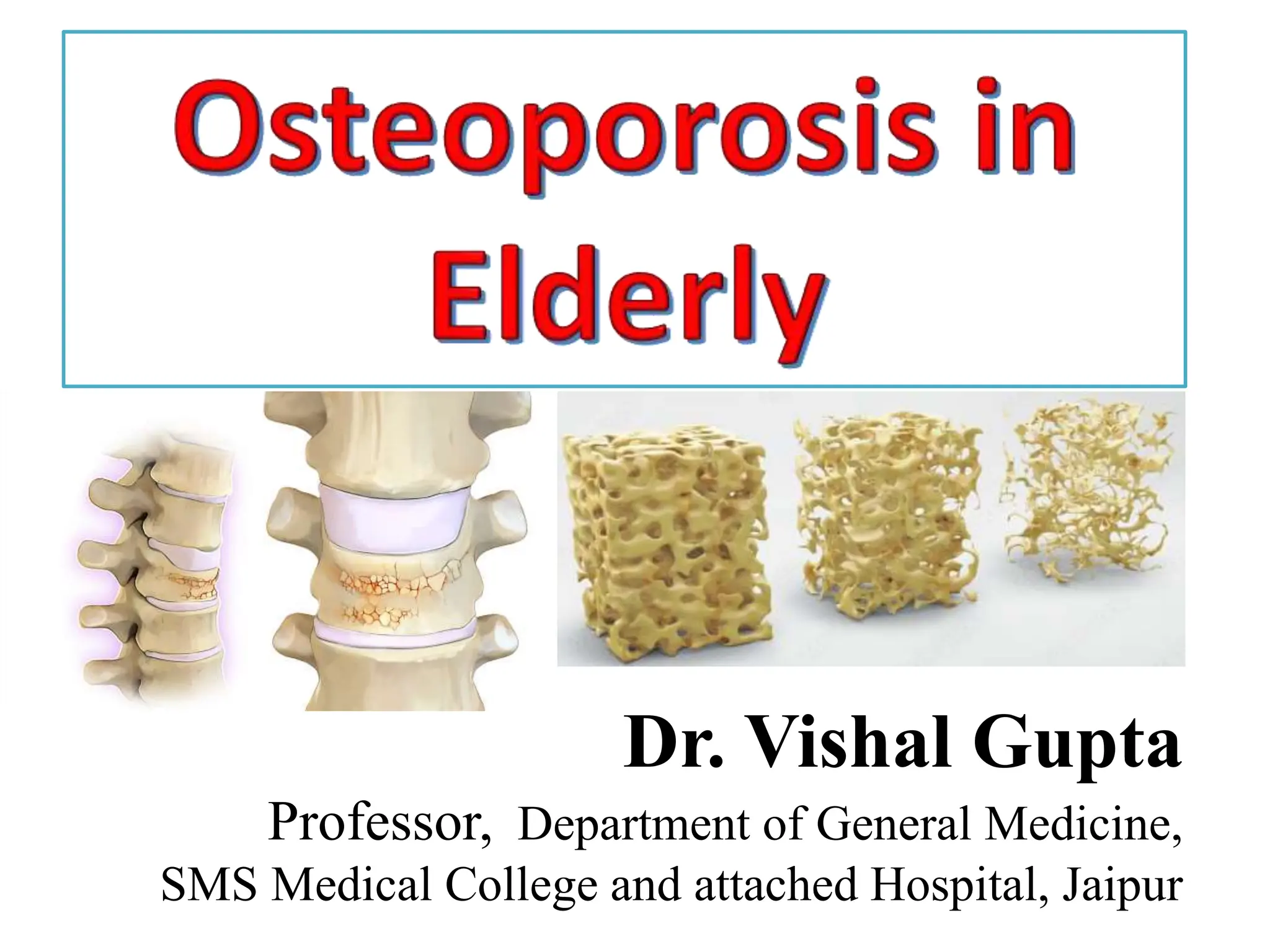 Osteoporosis in elderly causes and management | PPTX