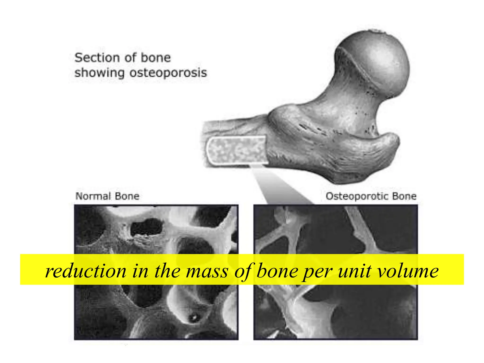 Osteoporosis in elderly causes and management | PPTX